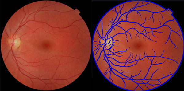 Hessian based segmentation